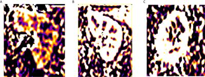 Arterial Spin Labeling MRI for Predicting Microvascular Invasion of T1 Staging Renal Clear Cell Carcinoma Preoperatively